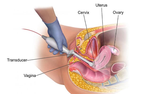 Vaginal ultrasound