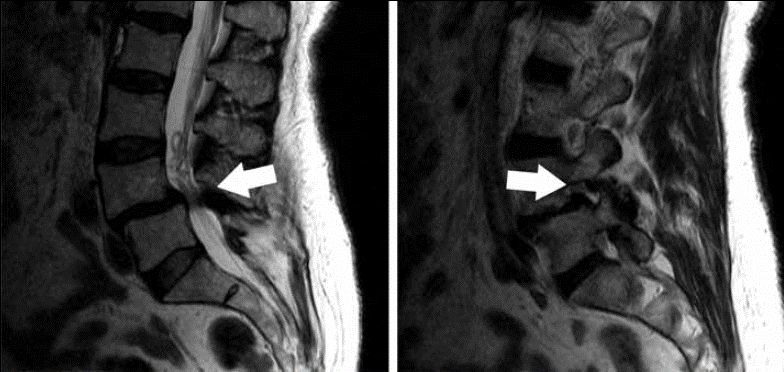Kemer MRI + Interpretation of Kemer MRI Response