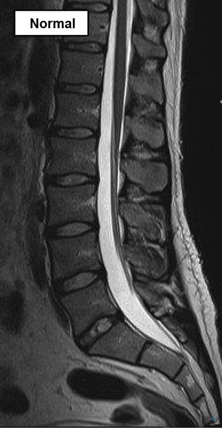Back MRI + Lumbar MRI Turn