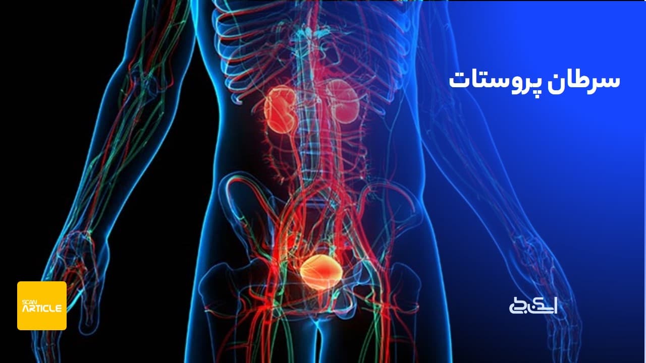 سرطان پروستات + نشانه های آن و ۷ روش درمان آن