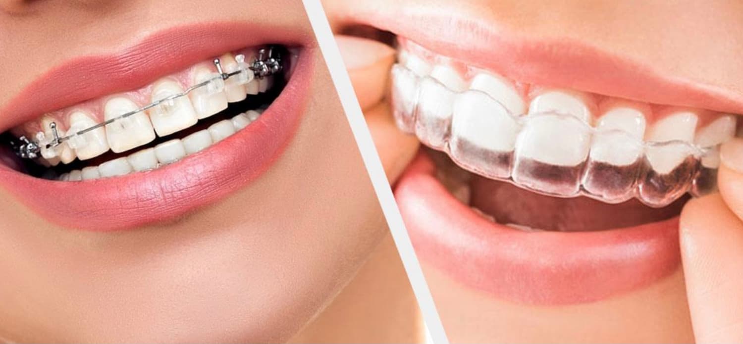 ارتودنسی دندان 6 مورد از انواع ارتودنسی+ مزایا و معایب