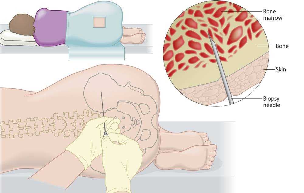 بیوپسی مغز استخوان چیست؟ 7 مورد از عوارض آن