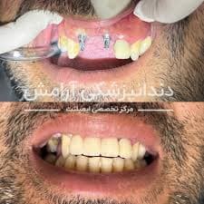 مرکز تخصصی ایمپلنت آرامش تهران