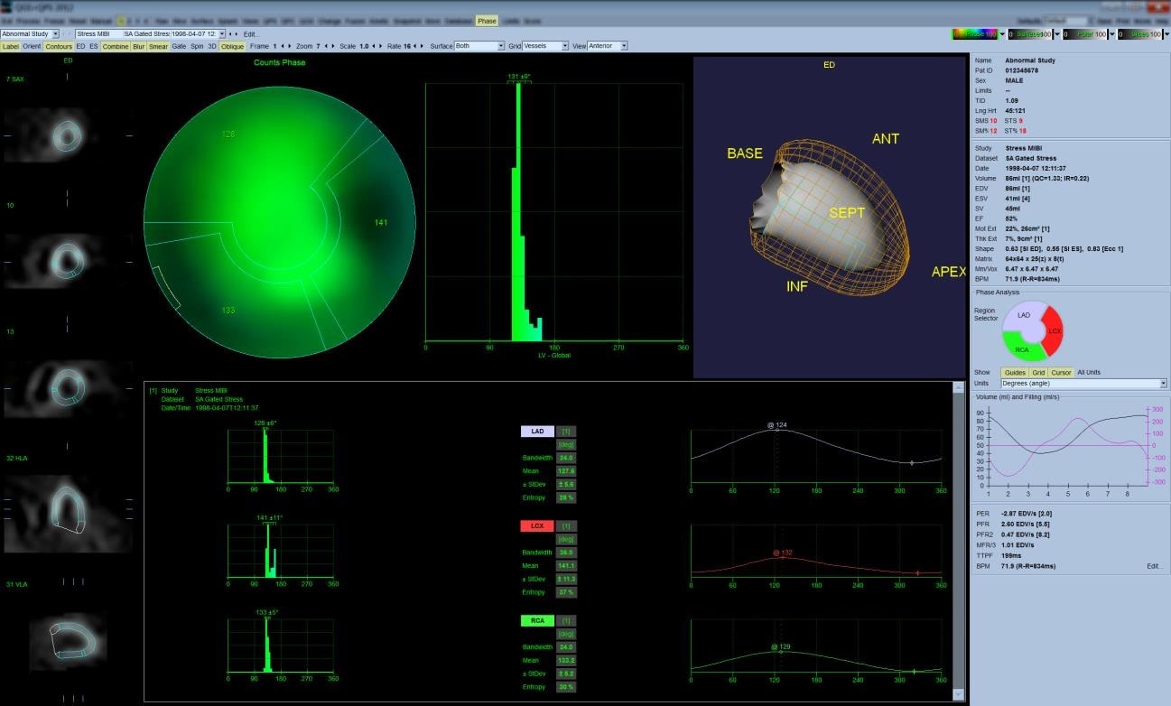 Cedars Sinai Software Phase Analysis Scanteb Nuclear Medicine
