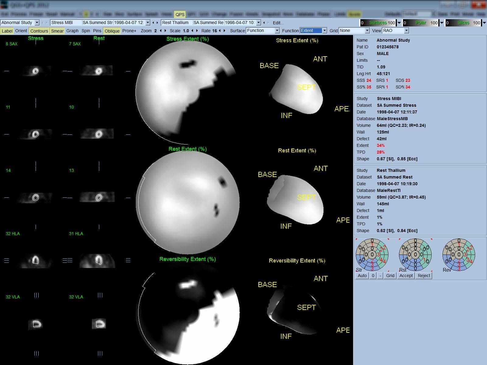 Cedars Sinai Software QPS Results Page Scanteb Nuclear Medicine
