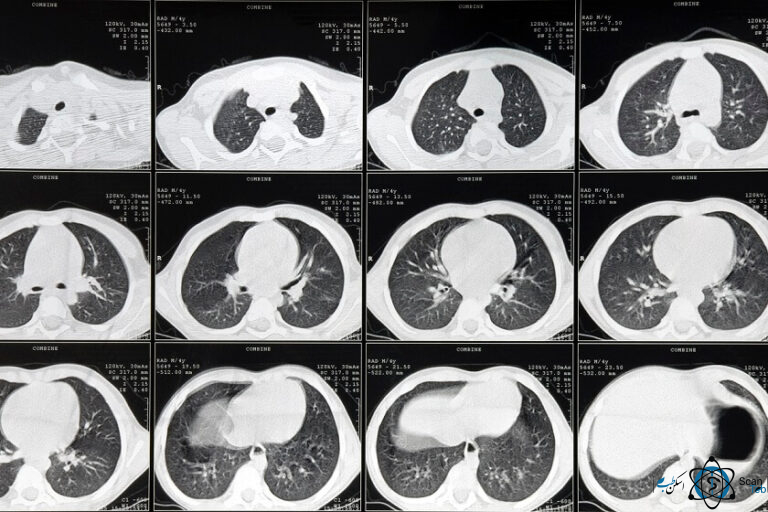 سی تی اسکن ریه