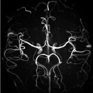 MRA ( MR Angiography ) یا آنژیوگرافی رزونانس مغناطیسی