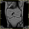 MRI Permanent XGY 0.4 Tesla Knee Scan