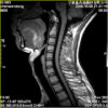 MRI Permanent XGY 0.4 Tesla Neck Scan