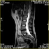 MRI Permanent XGY 0.4 Tesla Spine Scan