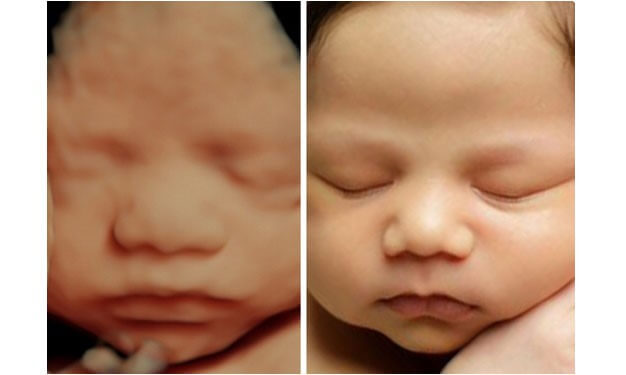 سونوگرافی سه بعدی از جنین