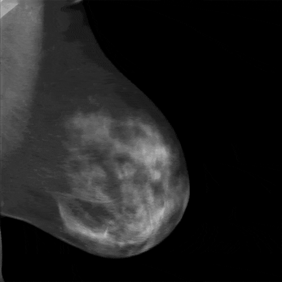 Interpretation of mammography response