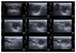 Thyroid ultrasound