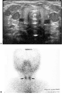 Thyroid ultrasound