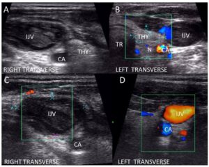 Thyroid ultrasound