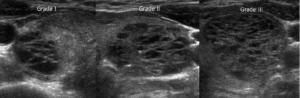 Thyroid ultrasound