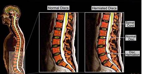 سی تی اسکن ستون فقرات کمر درد