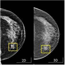 کاربرد ماموگرافی در تشخیص سرطان پستان