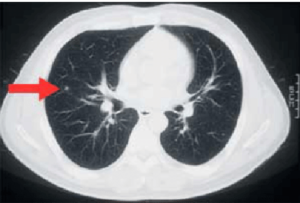 آیا سی تی می تواند تومورهای ریه را تشخیص دهد؟