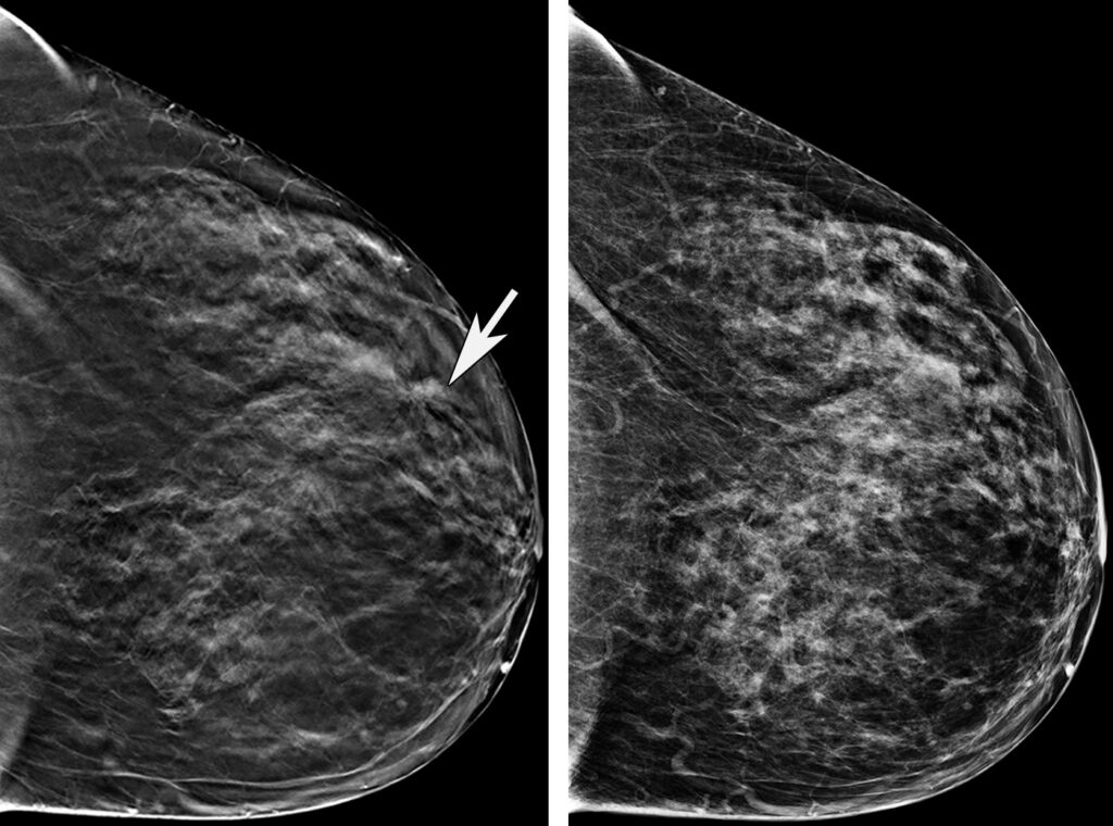 نمونه تصاویر ماموگرافی