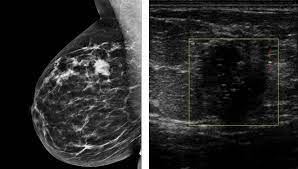 ماموگرافی بهتر است یا سونوگرافی؟