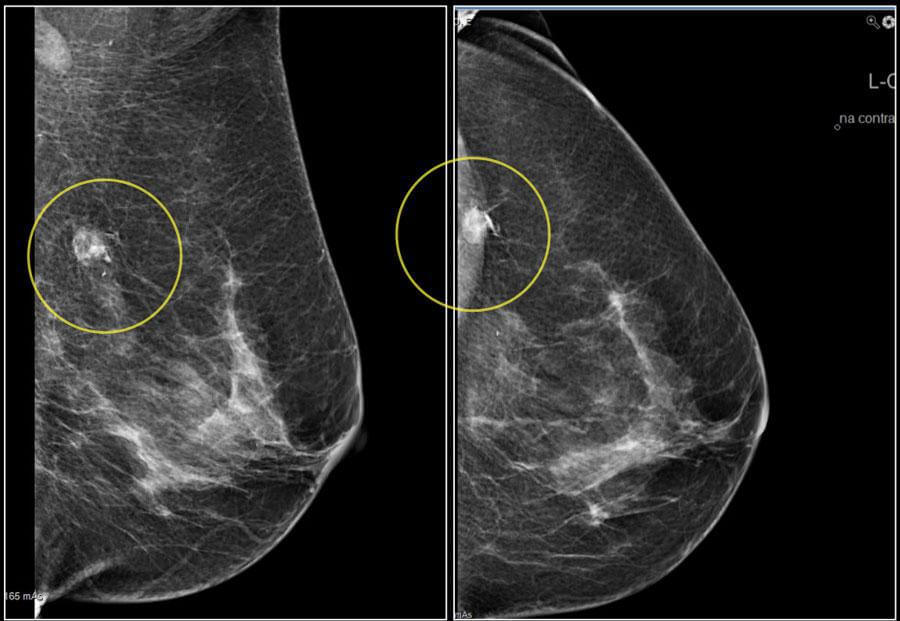 نمونه تصویر ماموگرافی سه بعدی
