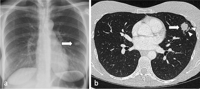Difference between lung CT scan and lung radiography