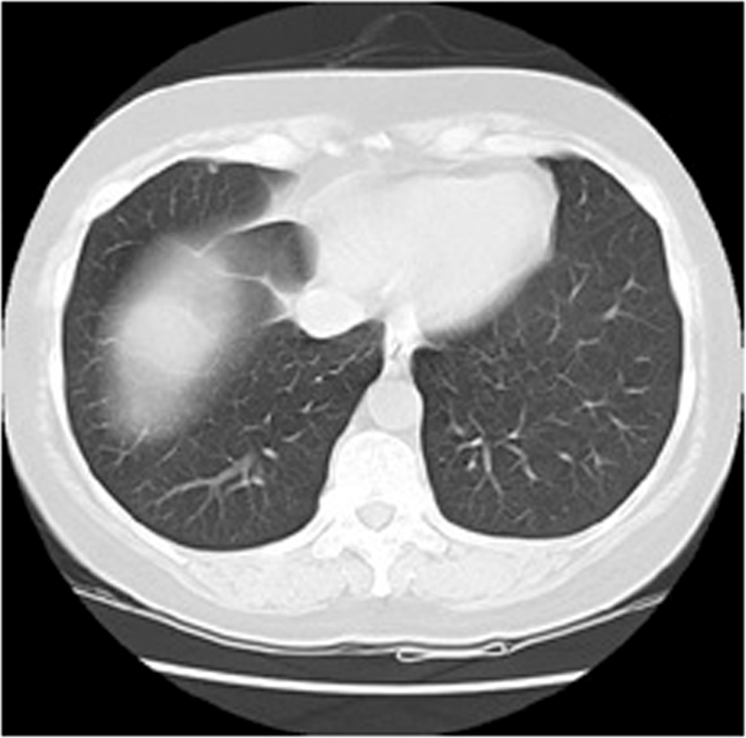 Difference between lung CT scan and lung radiography