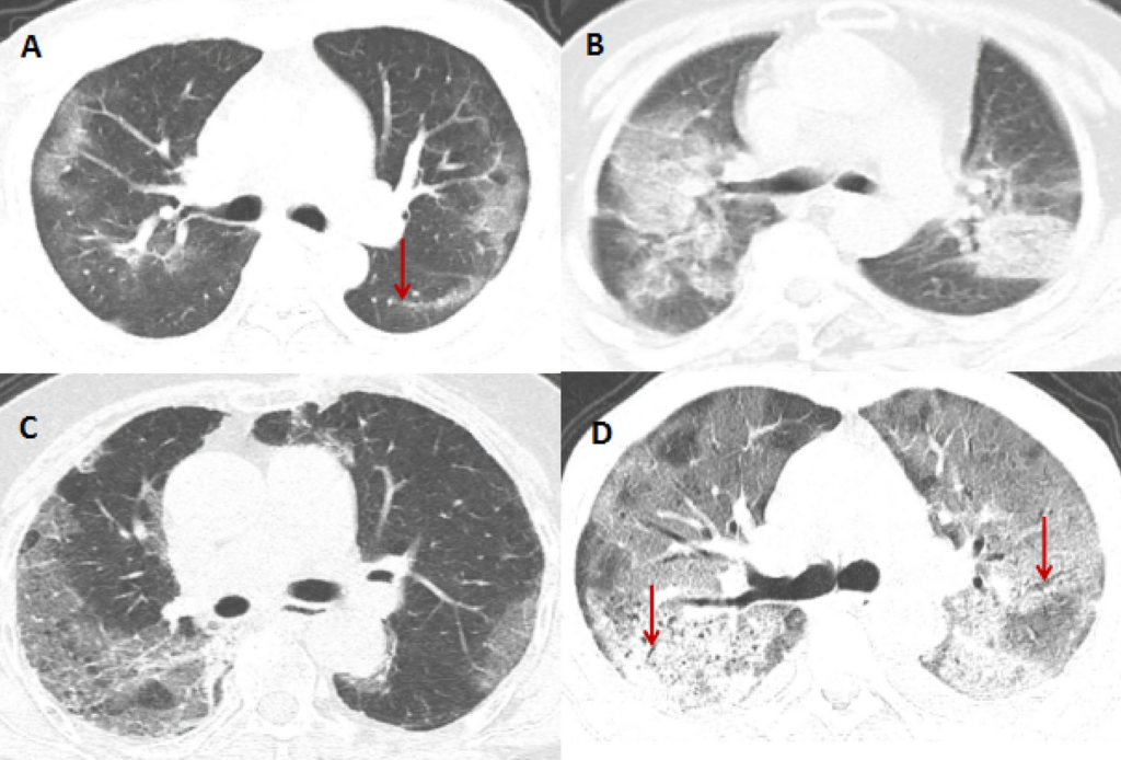 Difference between lung CT scan and lung radiography