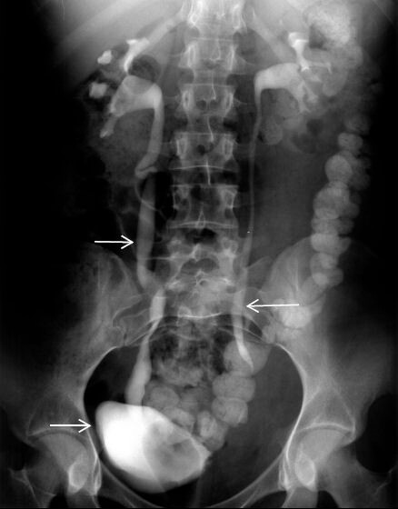رادیولوژی مجاری ادرار با تزریق به روش IVP 3