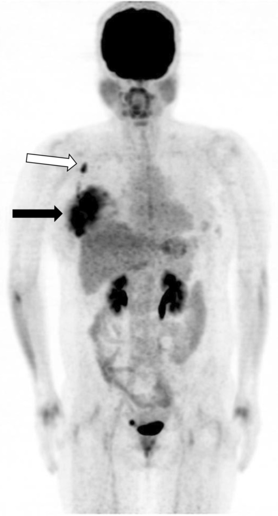 Interpretation of Pet Scan's answer