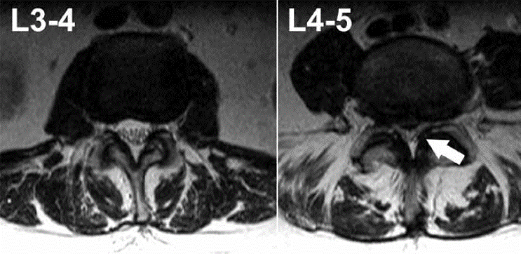 Kemer MRI+ Interpretation of Kemer MRI Response