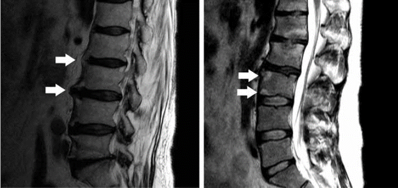 Kemer MRI+ Interpretation of Kemer MRI Response