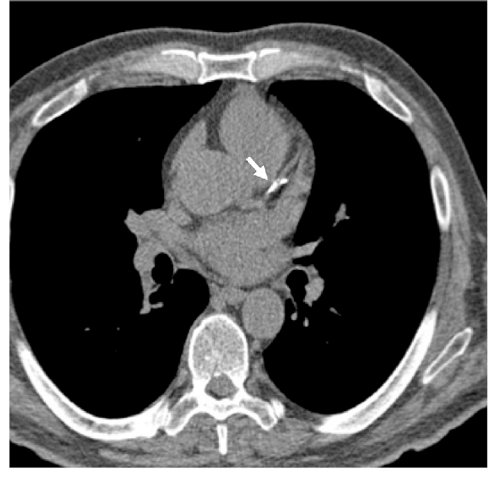 Diagnosis of heart disease with CT scan