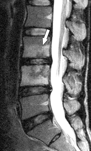 Lumbar MRI