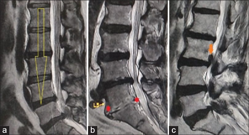 Lumbar MRI