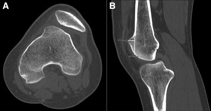 Knee CT scan