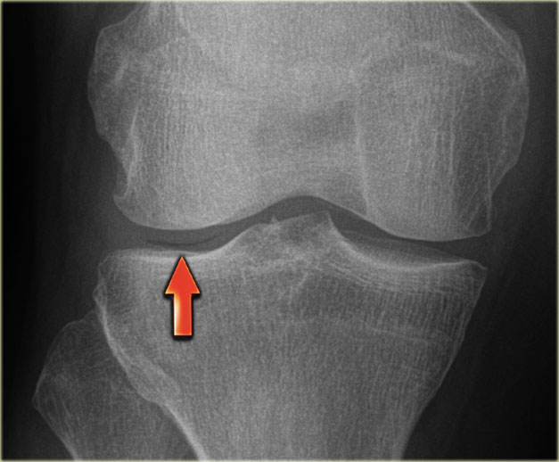 Knee CT scan
