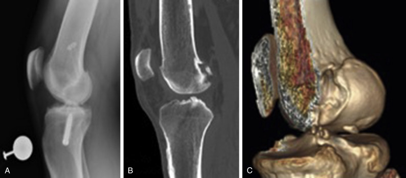 Knee CT scan