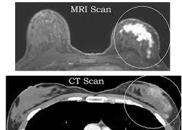 Breast CT scan compared to breast MRI