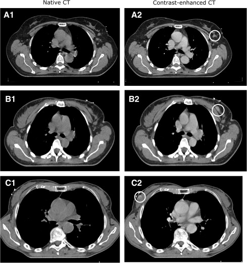 Breast CT scan