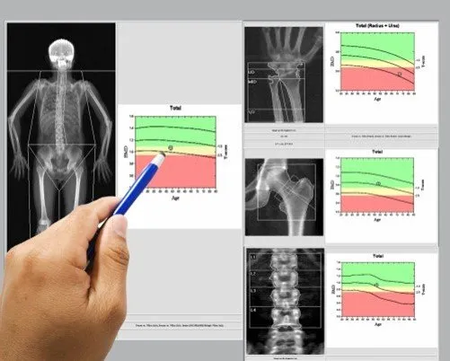 سنجش تراکم استخوان کرج