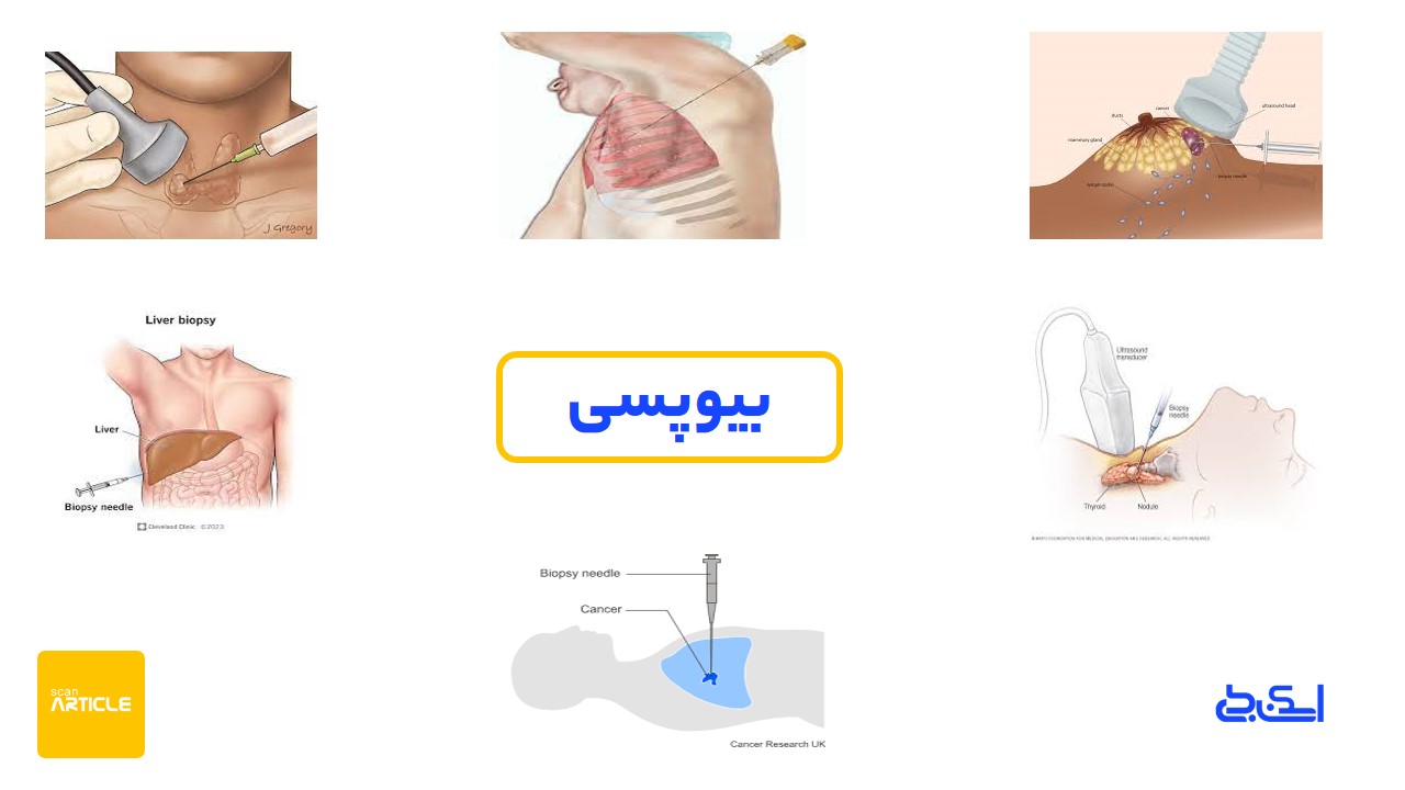 بیوپسی