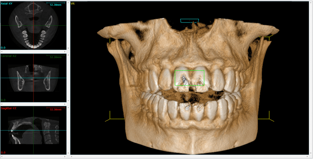 عکس CBCT چیست؟