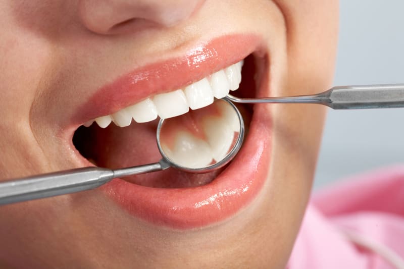 کامپوزیت دندان فلو چیست؟ 5 مورد از ویژگی های آن