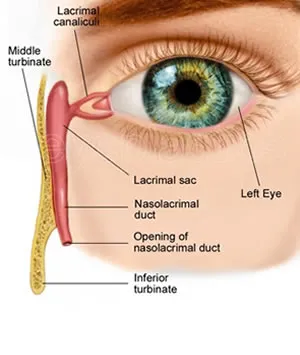 اسکن مجاری اشکی 1 Dacryocystorhinostomy-min