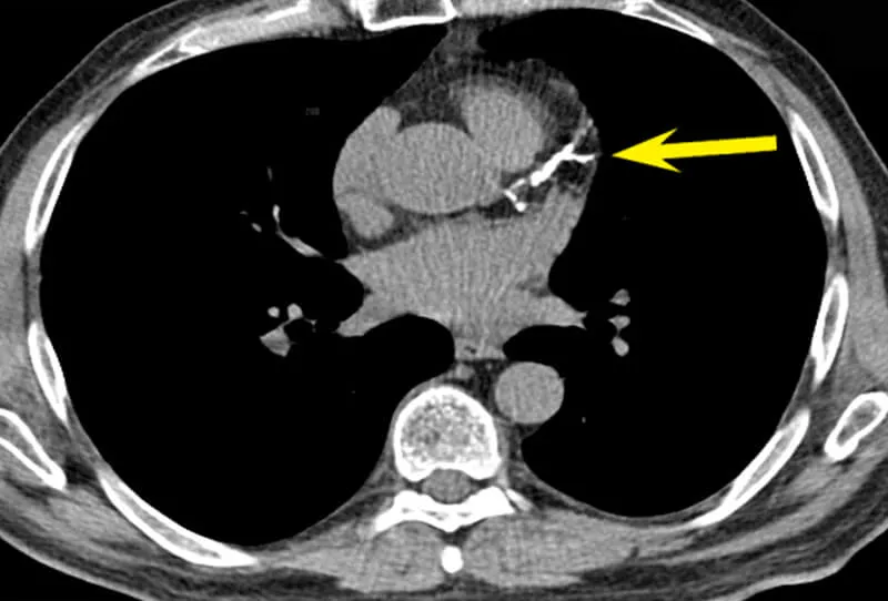 Diagnosis of heart disease with CT scan