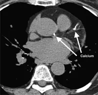 Diagnosis of heart disease with CT scan