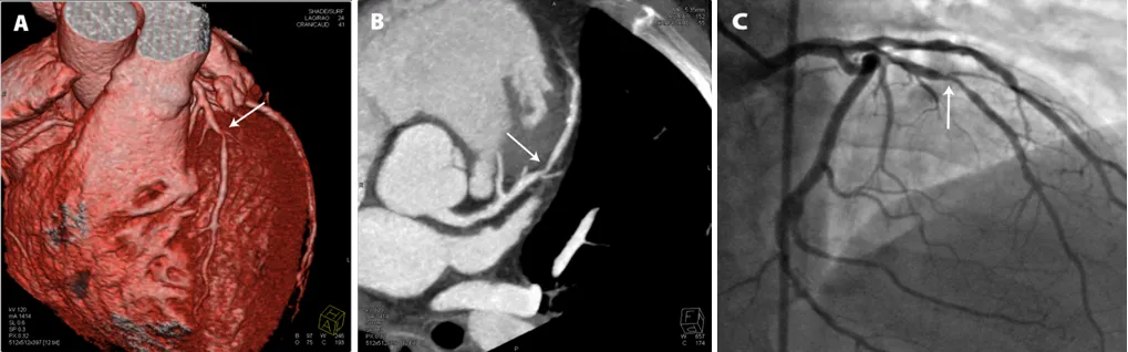 Diagnosis of heart disease with CT scan